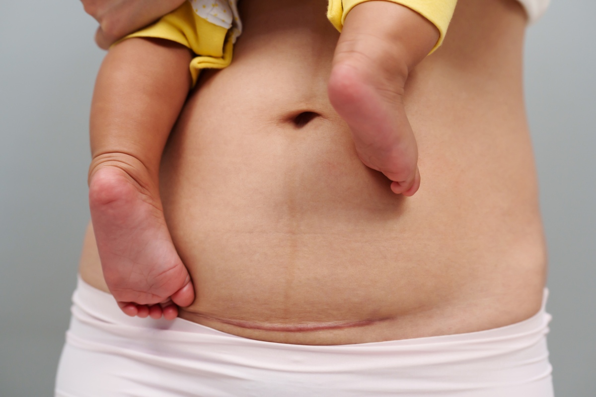 Postpartum abdomen with a horizontal cesarean scar, baby’s leg resting on the belly next to the scar.